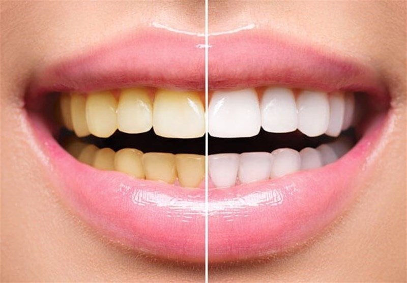 زیبایی دندان پیشنهاد دندانپزشکان برای زیبایی دندان چیست