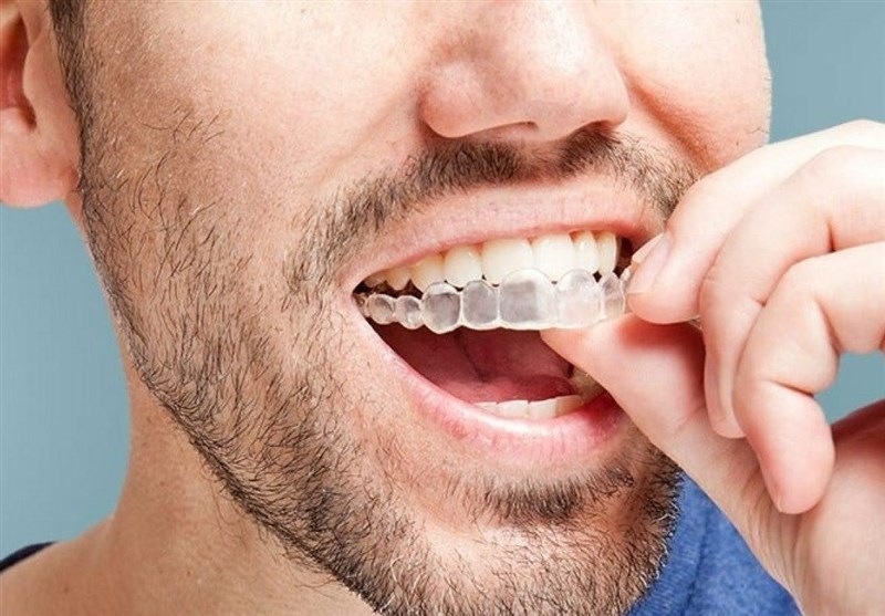 ارتودنسی نامرئی با الاینر شفاف به صرفه ترین روش مرتب کردن دندان ها