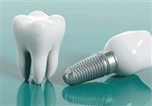 دندان پزشکی اقساطی بهترین راه برای مدیریت هزینه ایمپلنت دندان