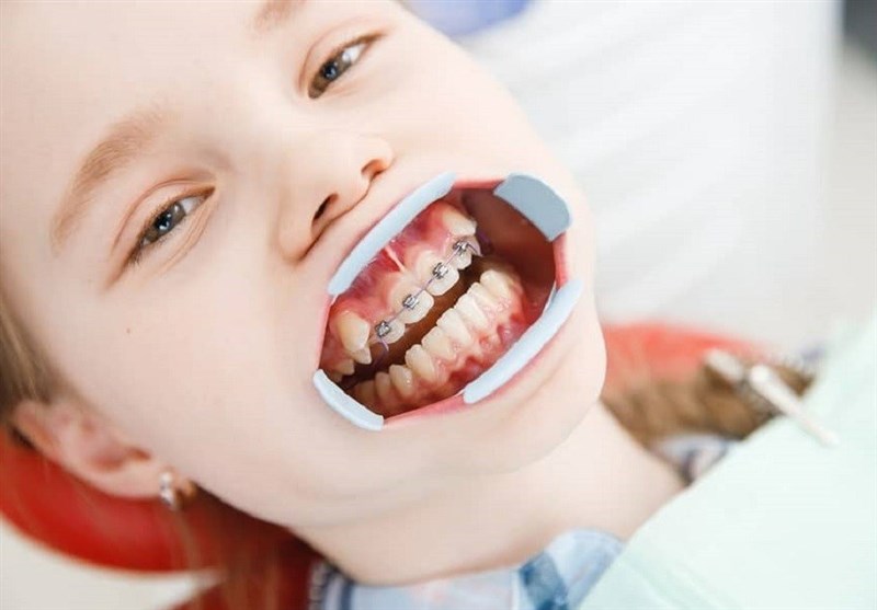 آیا کشیدن دندان شیری برای ارتودنسی توصیه می‌شود؟