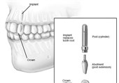 برای ایمپلنت دندان به کجا مراجعه کنیم؟