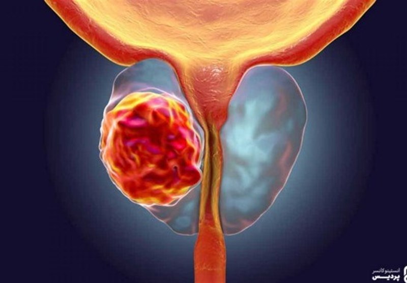 سرطان پروستات بیماری شایع در مردان/ مردان بالای 50 سال این آزمایش خون را انجام دهند