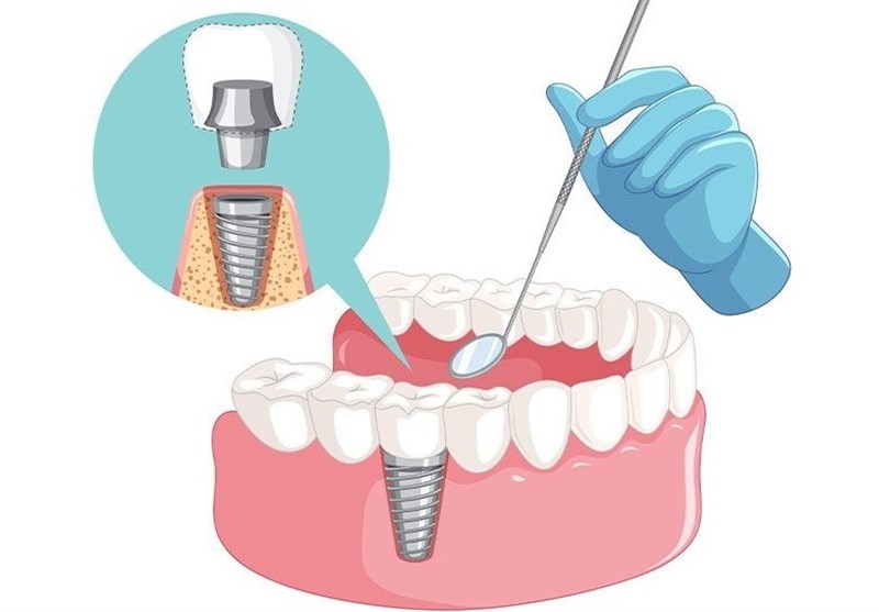 کامپوزیت دندان با شرایط اقساط در کلینیک زیبایی آتن