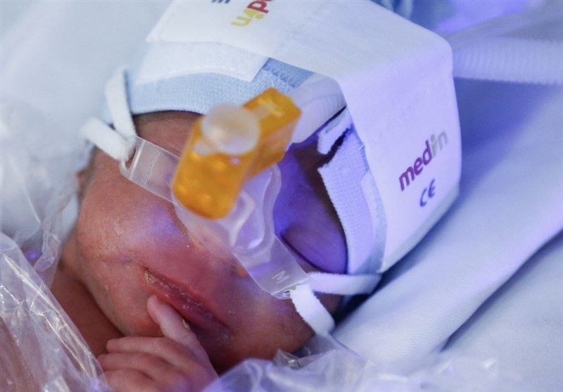 پیشگیری از نابینایی 280 نوزاد در فارس با درمان رتینوپاتی