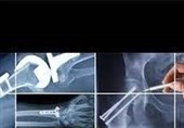 ثبت دستاورد جدید پزشکی در مشهد/ ساخت پلاک استخوانی کوتاهکننده و بلندکننده