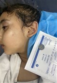 کودک اهل غزه که از سر گرسنگی باتری ساعت بلعیده بود