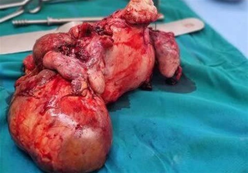 تومور 16 کیلویی از شکم بیمار ترکمنستانی در مشهد خارج شد