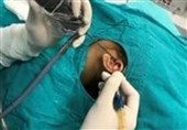 اولین عمل جراحی اندوسکوپیک ترمیم پارگی پرده گوش در طبس