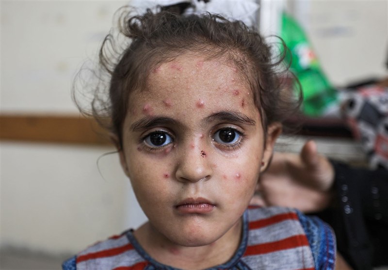انتشار واسع للأمراض الجلدیة بین الأطفال النازحین فی قطاع غزة