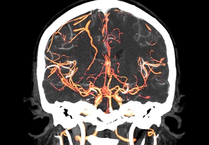 Scientists Identify Potential Early Markers of Schizophrenia in Brain Scans