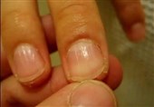 Doctor Warns Serious Heart Condition Sign Could Be Detected in Nails