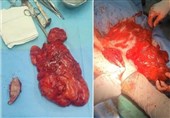 خارج کردن توده 5 کیلویی از شکم خانم سنندجی!