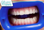 عفونت‌های لثه و پیامدهای انتخاب نادرست خدمات دندانپزشکی
