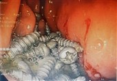 خارج کردن 47 پیچ فلزی از معده یک بیمار در کرج