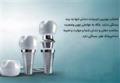 بهترین برندهای ایمپلنت دندان در ایران از نگاه متخصصان
