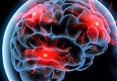 Ядерное достижение Ирана: иранский радиофармацевтический препарат позволяет обнаружить болезнь Альцгеймера на 20 лет раньше