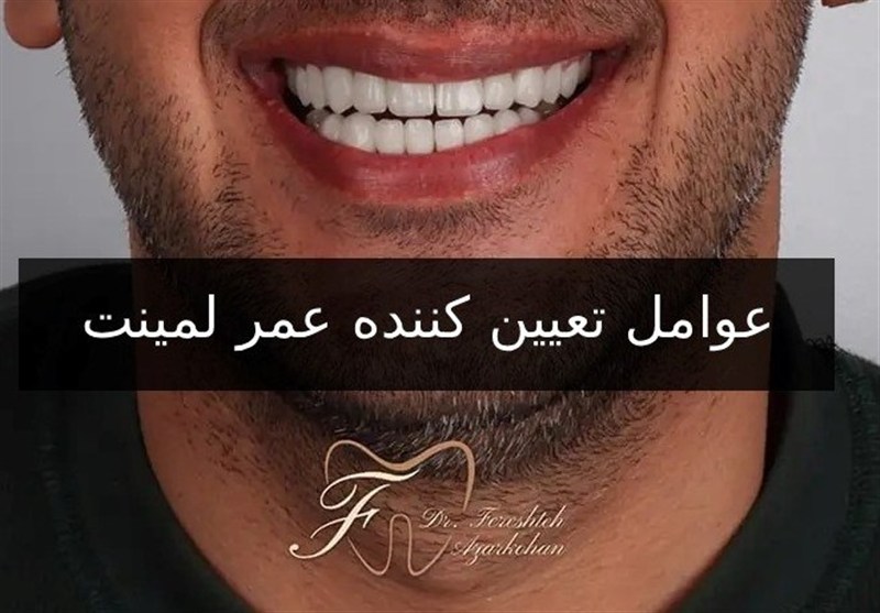 عمر لمینت دندان : لمینت دندان چقدر عمر می‌کند؟