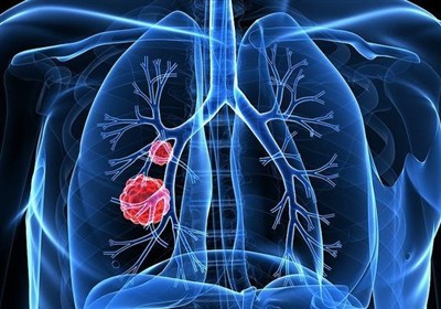 درمان،ريه،سرطان،پيشرفته،شركت،سرطاني،هوش،مصنوعي،اثربخشي،هدفمن ...