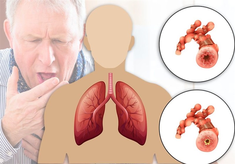 ابتلای 10 میلیون ایرانی به آسم و انسداد ریوی / غلظت آلایندههای هوای تهران 30 برابر حد مجاز