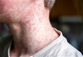 US Measles Outbreaks Spread As Vaccination Rates Slip