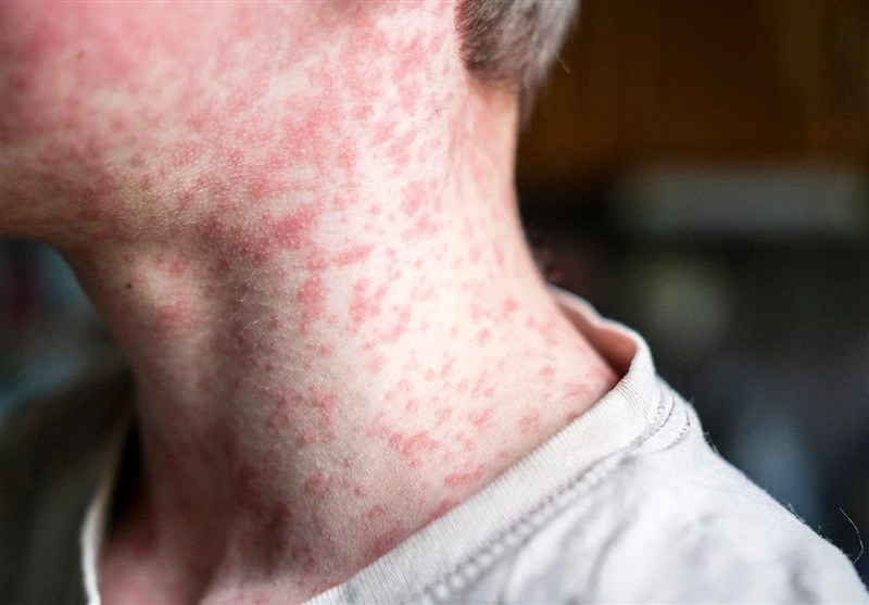 US Measles Outbreaks Spread As Vaccination Rates Slip
