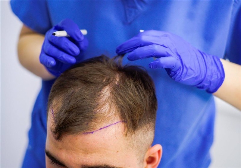 بهترین سن برای کاشت مو اقایان