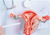 یک زن از هر 10 نفر دچار آندومتریوز می‌شود