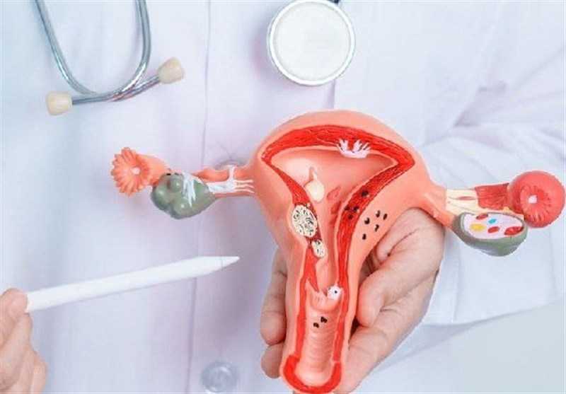 یک زن از هر 10 نفر دچار آندومتریوز می‌شود